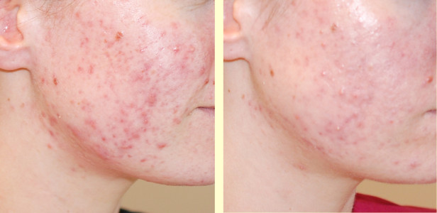 getuigenis Mysterie te veel acne LED lichttherapie gezicht | Atossa Huid en Oedeemtherapie